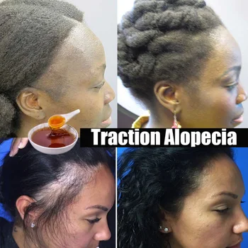 Масло Для Быстрого Роста Волос African Crazy Traction Alopecia Chebe Маска Для Волос Против Ломкости Волос Укрепитель Волос Спрей Для Лечения Выпадения Волос