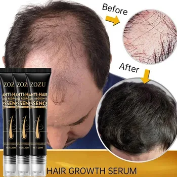 Эфирное масло для мощного роста волос Предотвращает облысение, лечит фолликулы кожи головы, сыворотки для быстрого отрастания, средства против облысения и выпадения волос